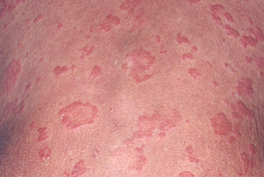 Cryopyrin-Associated Periodic Syndromes (CAPS) Cutaneous Findings