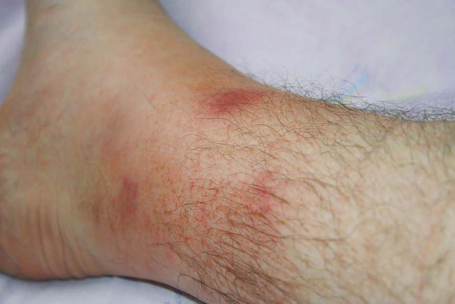 Familial Mediterranean Fever (FMF) Cutaneous Findings
