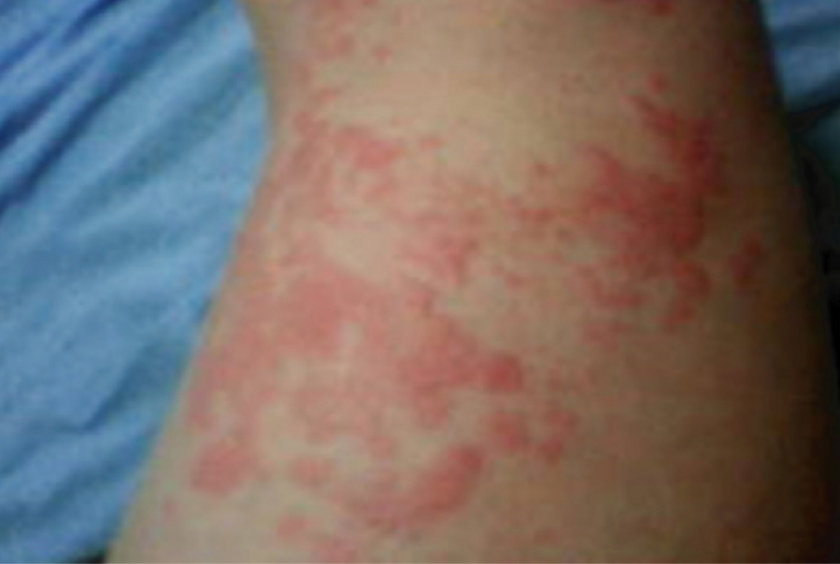 Familial Mediterranean Fever (FMF) Cutaneous Findings