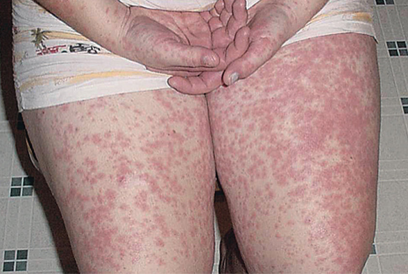 HIDS/MKD Cutaneous Findings
