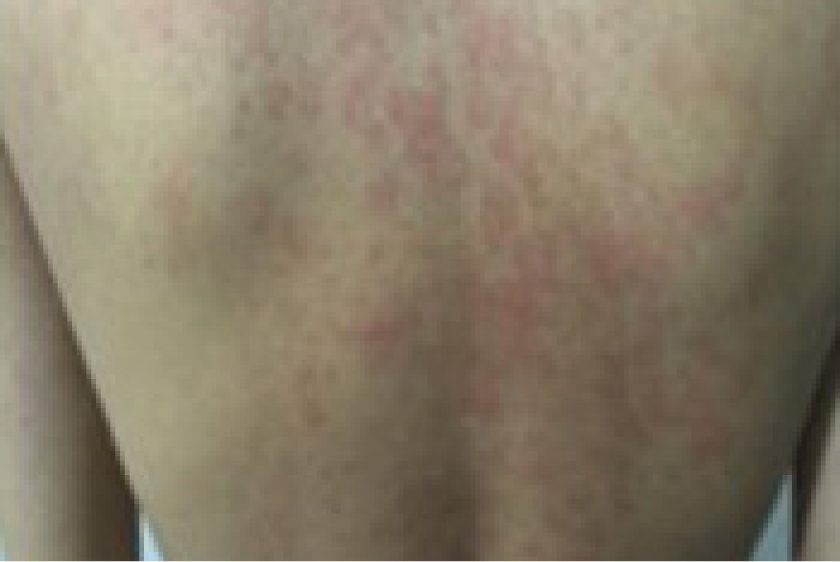 Tumor Necrosis Factor Receptor Associated Periodic Syndrome (TRAPS) Cutaneous Findings