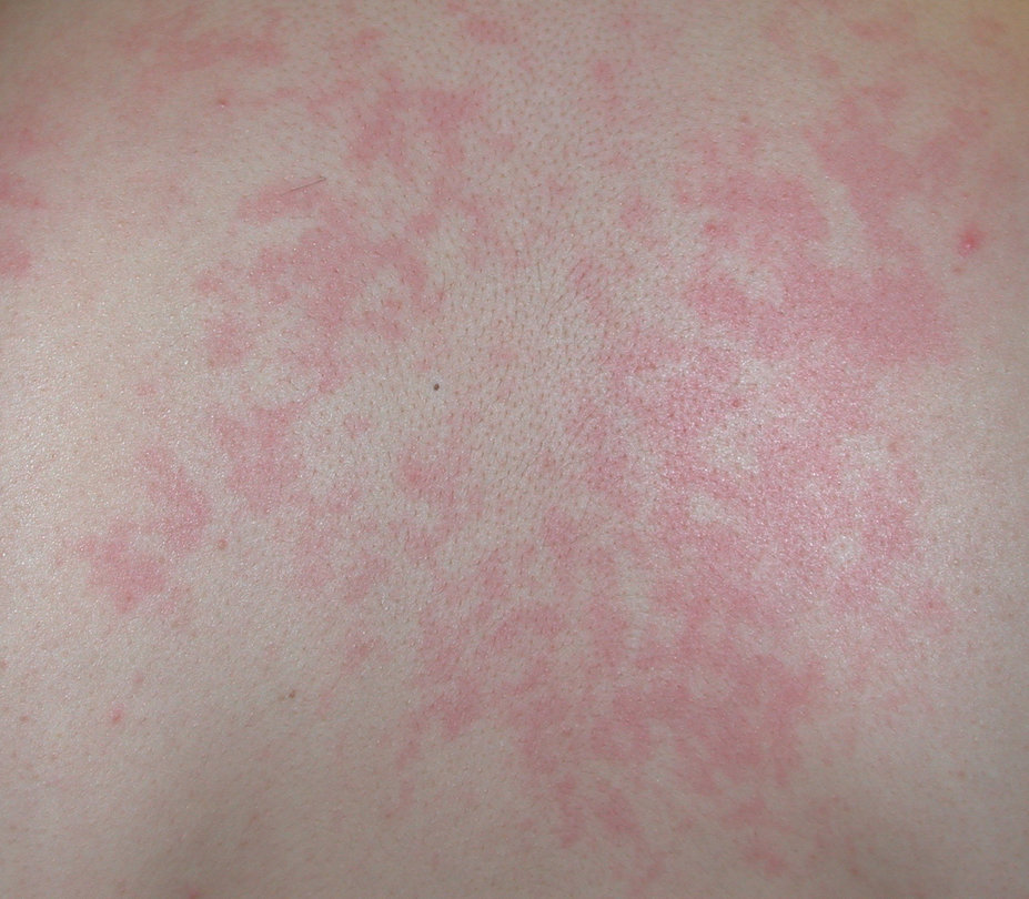 Adult-onset Still's Disease (AOSD) rash.
