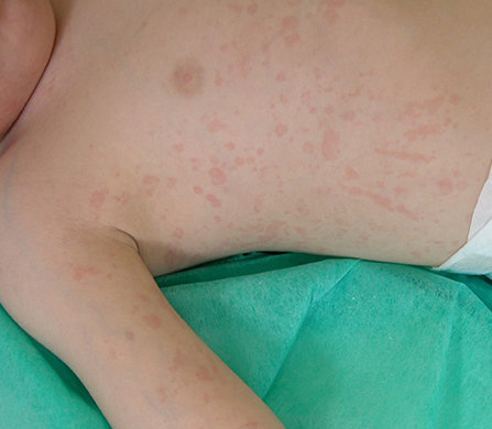 Systemic juvenile idiopathic arthritis (SJIA) rash.